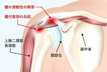 肩関節周囲炎