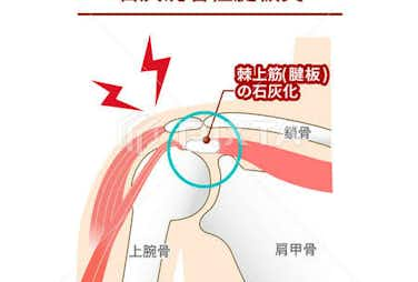 石灰沈着性腱板炎/