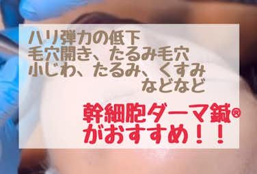 幹細胞ダーマ鍼