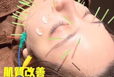 秋のお肌に100本美容鍼