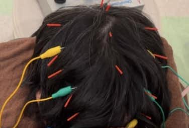 脱毛症　頭皮鍼　幹細胞ダーマ鍼