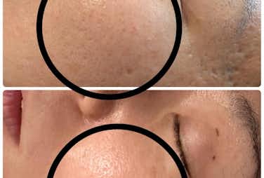 幹細胞ダーマ鍼×電気美容鍼の効果