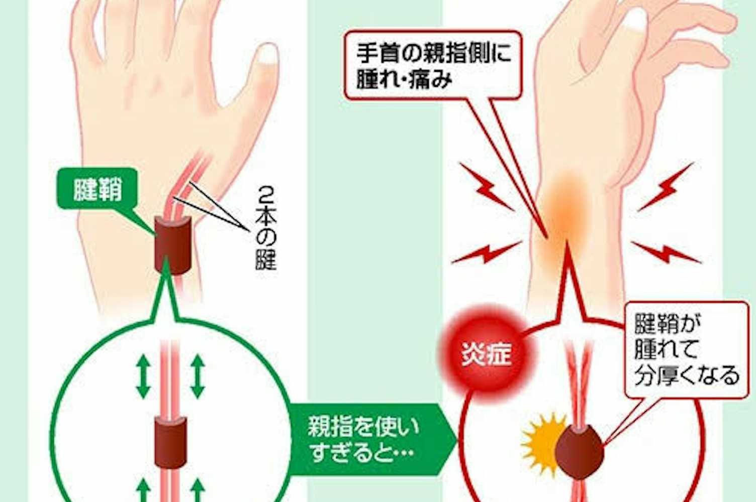 腱鞘炎 超 音波 治療