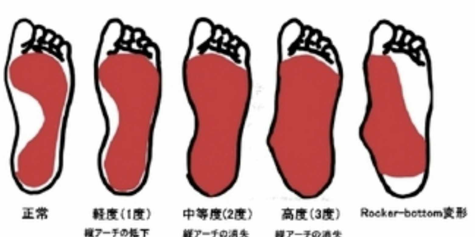 扁平足矯正 公式 ふじもり桜花整骨院のブログ 八王子の地域情報ポータルサイト はちなび