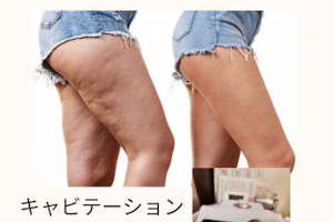 セルライトの正体は「血行不良」が原因の一つ　アワード八王子