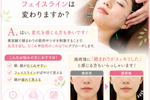 美容鍼で顔のむくみやフェイスラインは変わりますか？