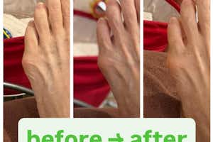 内反小趾の治療は八王子ふじもり桜花整骨院