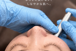 美容鍼とダーマ鍼で美肌効果