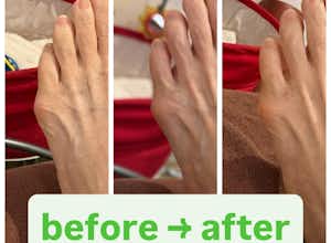 内反小趾の治療は八王子ふじもり桜花整骨院