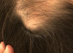 円形脱毛症の治療、薄毛治療