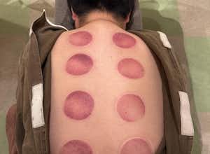 体の凝りなどアスリートもやってるカッピング治療