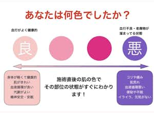 カッピング、吸玉治療は八王子ふじもり桜花整骨院