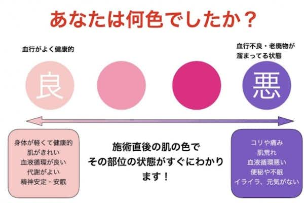 カッピング、吸玉治療は八王子ふじもり桜花整骨院